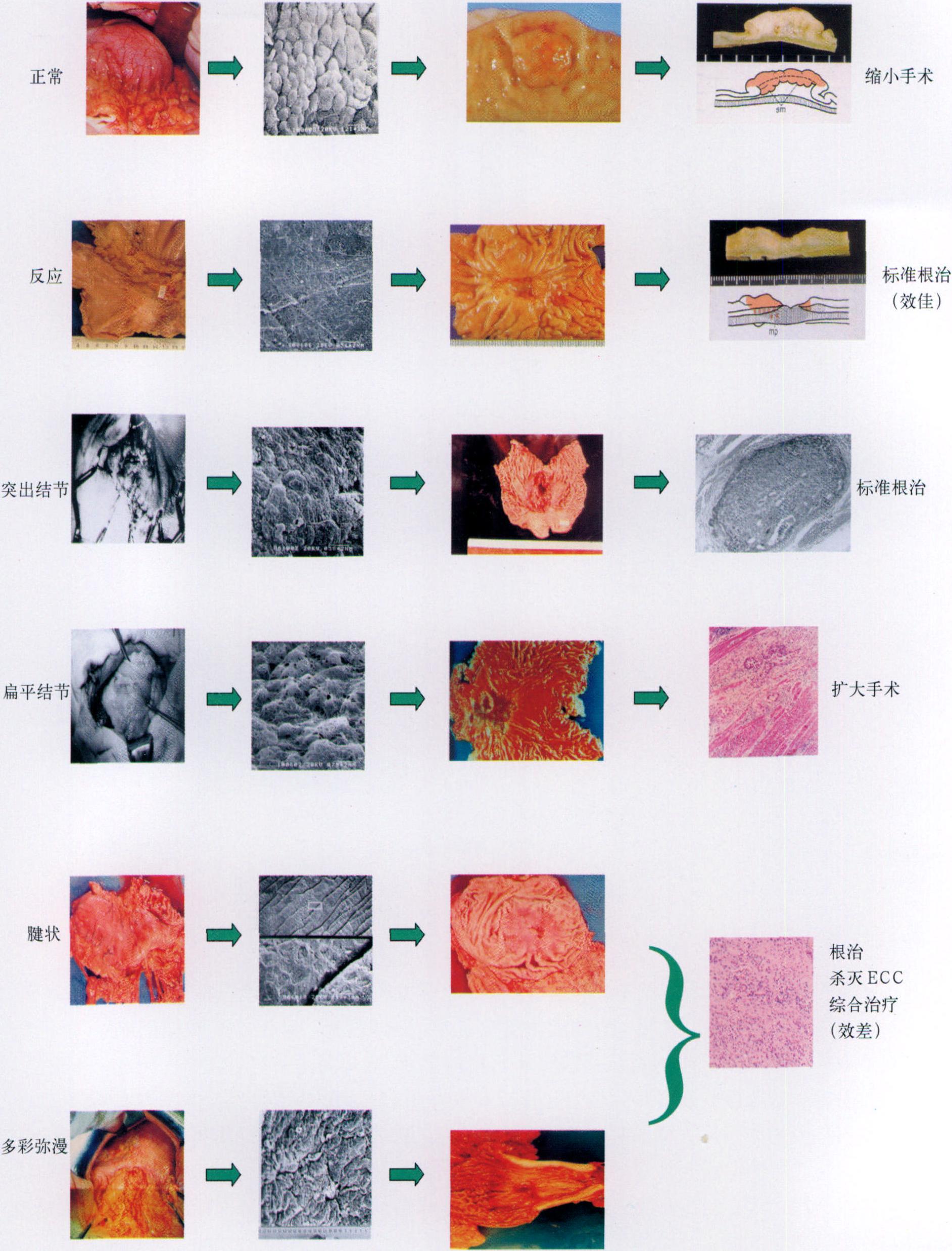 3.5 胃癌生物學行為的臨床應用